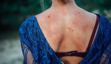 I'm a mosquito expert – this is why some people get more bites