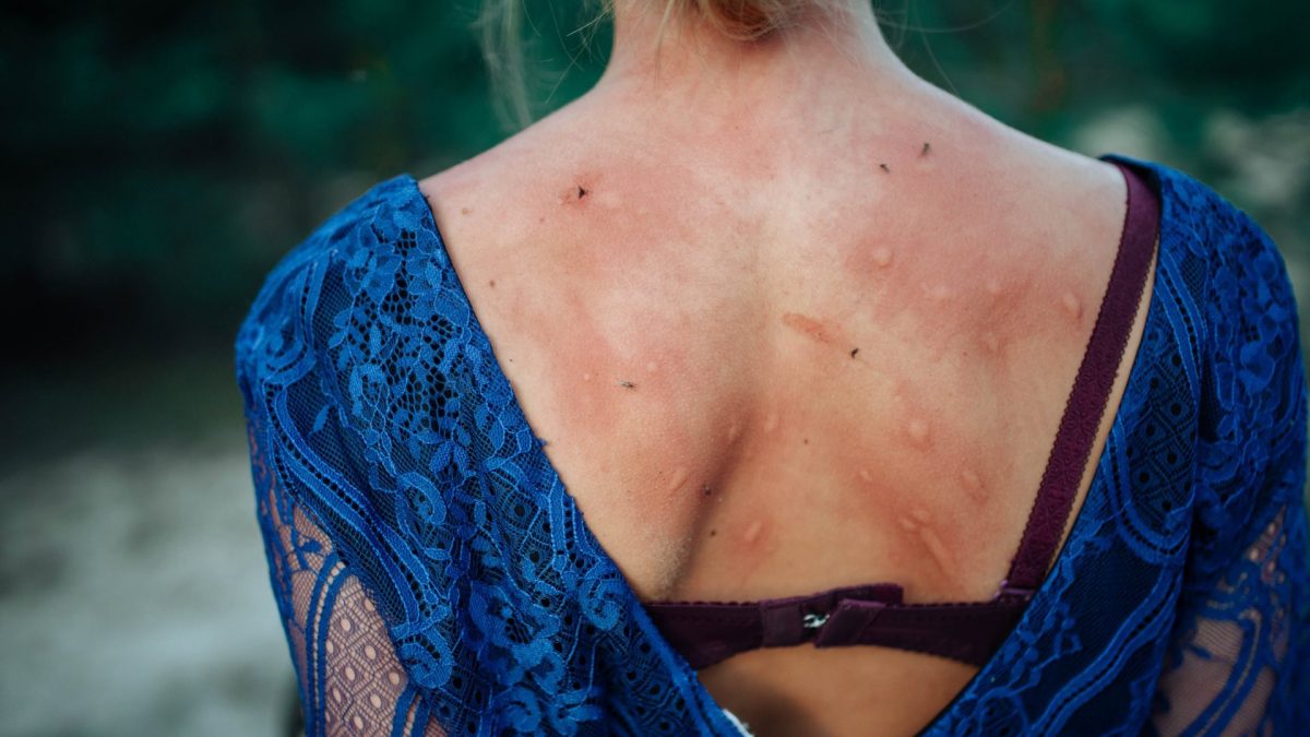 I'm a mosquito expert – this is why some people get more bites