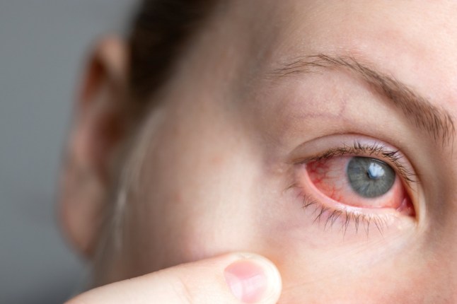 Close up of a woman showing a red infected eye with conjunctivitis. Health care concept
