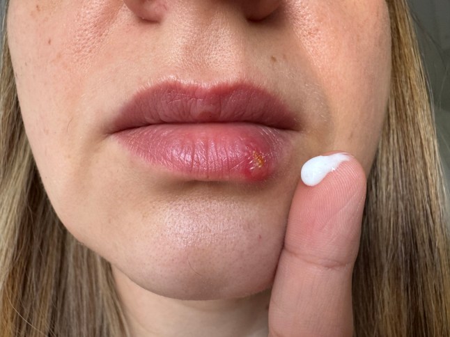 Close-up of a woman applying topical cream to a cold sore on her lower lip, illustrating personal care, home treatment, skincare routine, minor injury care and medical self-treatment concepts.