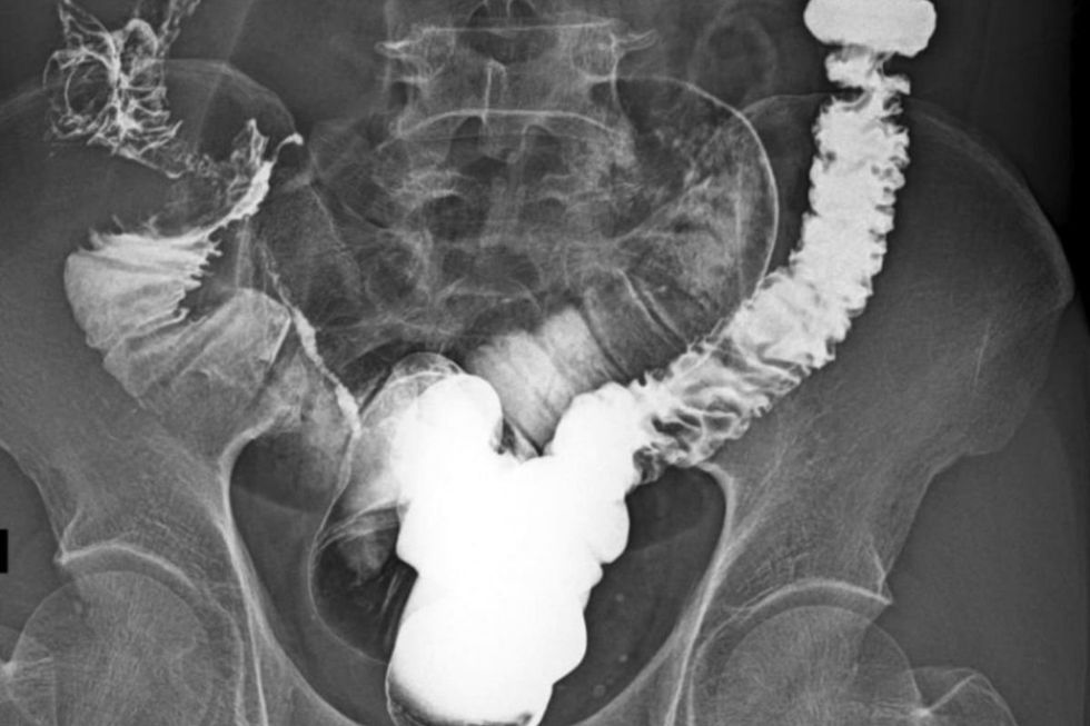 COLON X-RAY