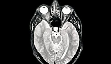 Alzheimer's: Middle-aged people with NO memory problems offered Alzheimer's drug in world first