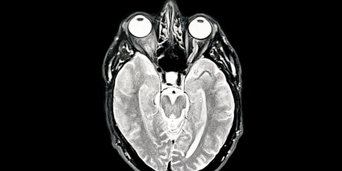 Alzheimer's: Middle-aged people with NO memory problems offered Alzheimer's drug in world first