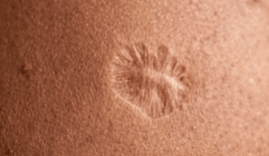 Millions of people around the world realise they have the exact same scar