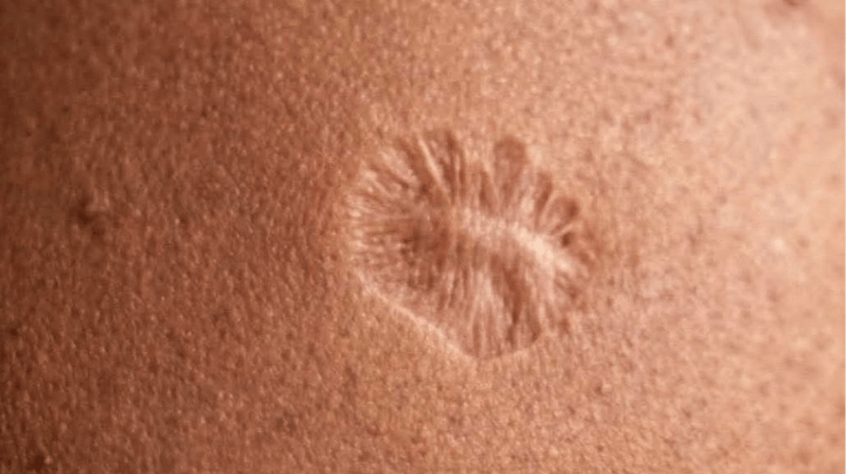 Millions of people around the world realise they have the exact same scar
