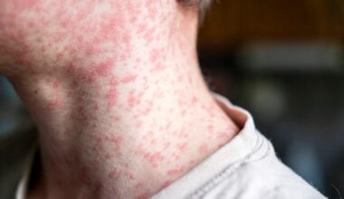 Map reveals UK measles hotspots, as Victorian disease hits 1,000 cases