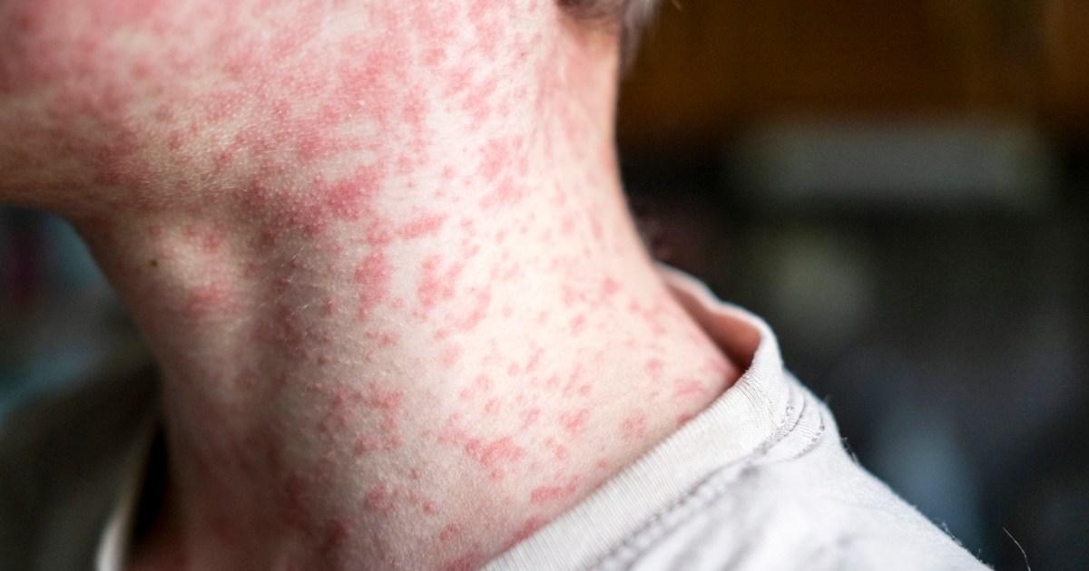 Map reveals UK measles hotspots, as Victorian disease hits 1,000 cases