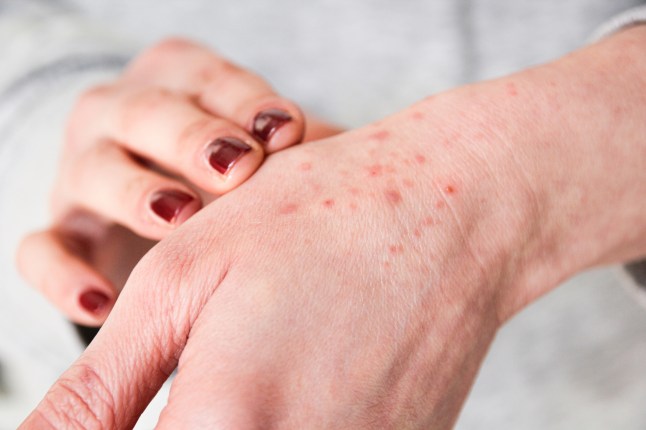 Itchy skin rash bumps caused by harvest mites