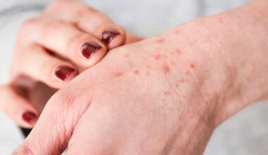 A parasitic bug that eats human skin cells is thriving in the UK right now