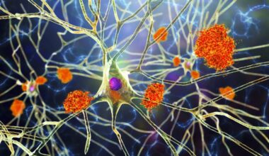 The drugs that could slow Alzheimer's