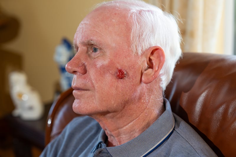 John McGahey at home in Enniskillen.  He has developed a cancerous lesion which he is concerned about and is hoping to have removed.  Picture: Ronan McGrade