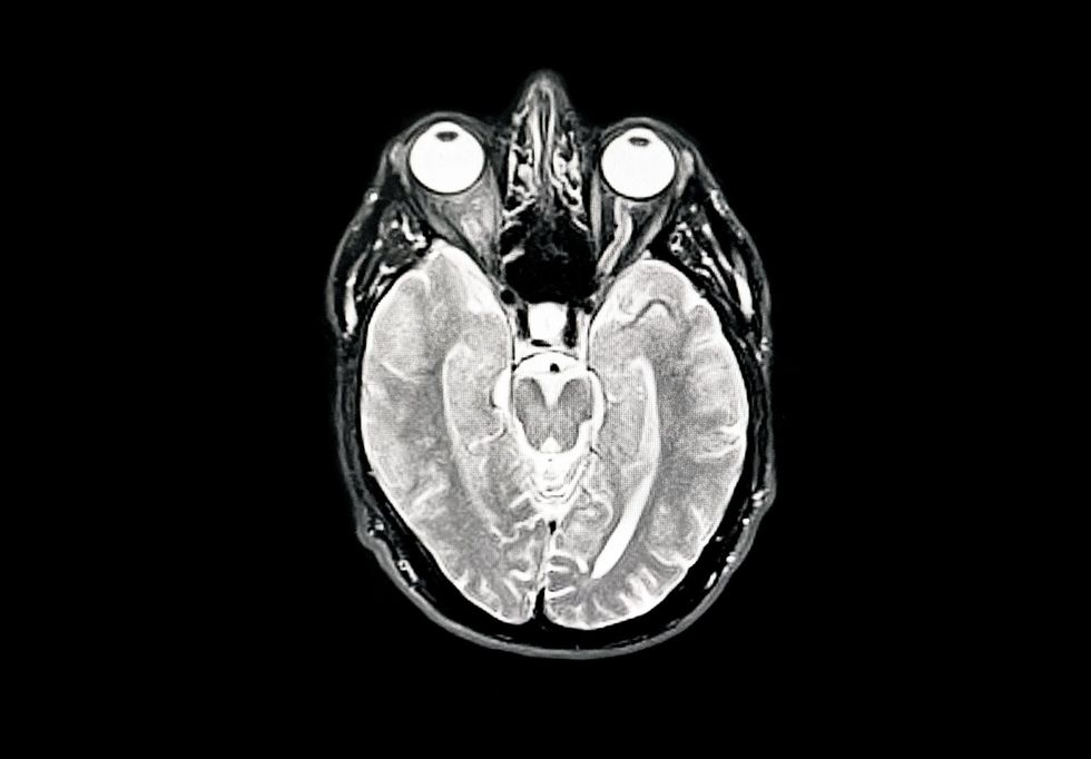 Alzheimer's disease