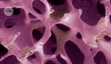 Osteoporosis affects millions: could modified cells rebuild their bones?
