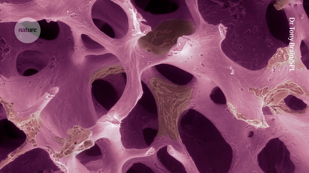 Osteoporosis affects millions: could modified cells rebuild their bones?