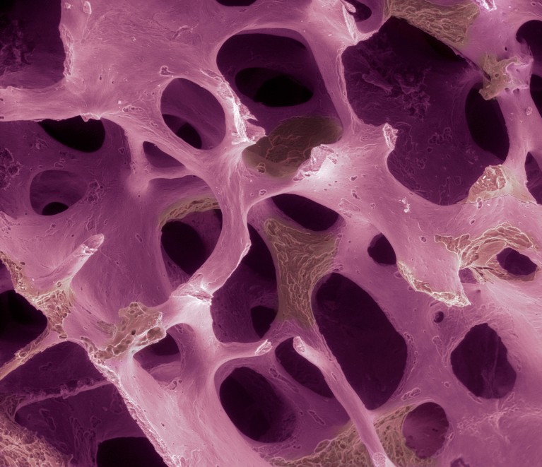 Coloured scanning electron micrograph of osteoporotic bone, showing a highly porous lattice of interconnected holes and thinning bone, creating a sponge-like structure in shades of pink and purple