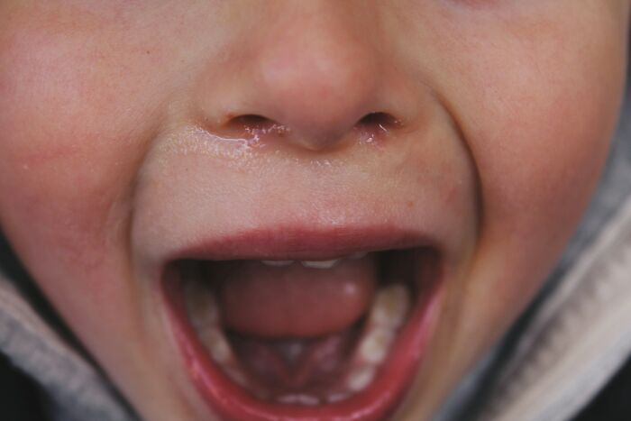 A close-up of a child with an open mouth, illustrating historical medical practices.