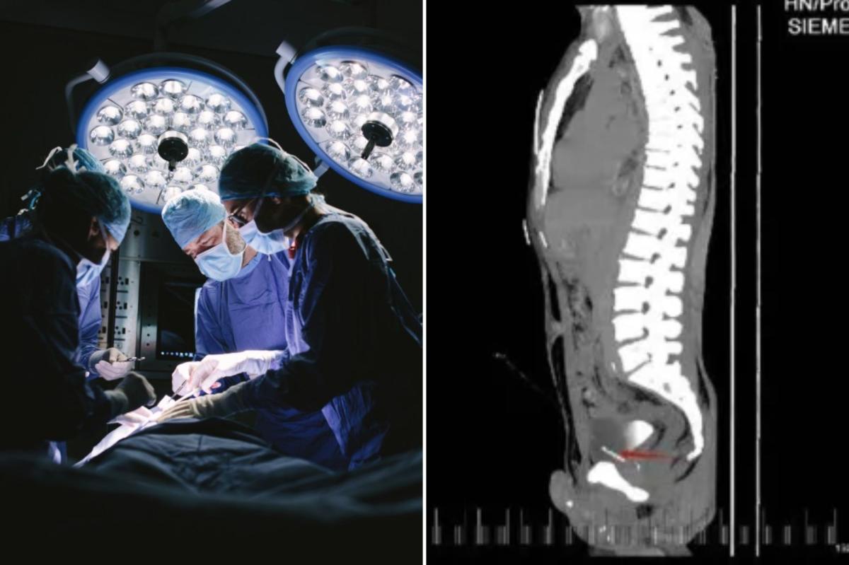Doctors find 'foreign bodies' inside a man's chest, penis