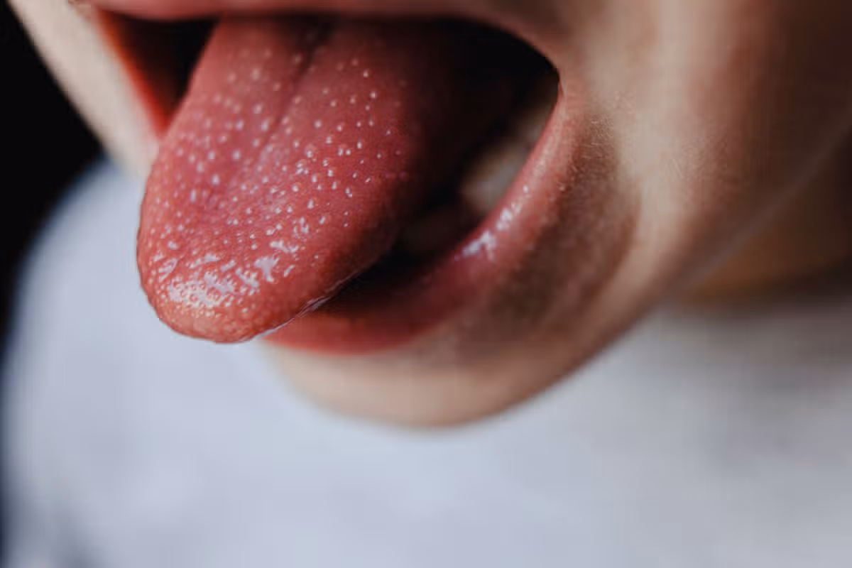 Boy with scarlet fever tongue