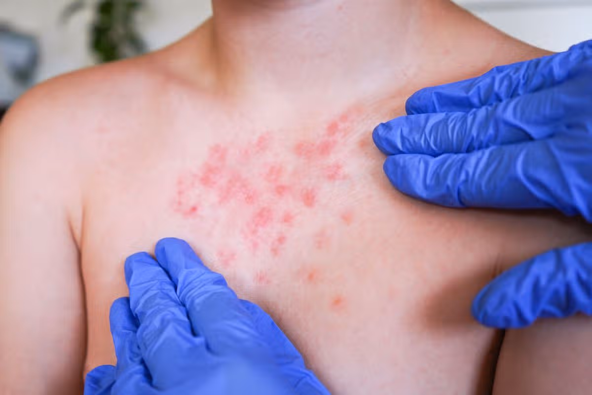 The boy's skin rash a