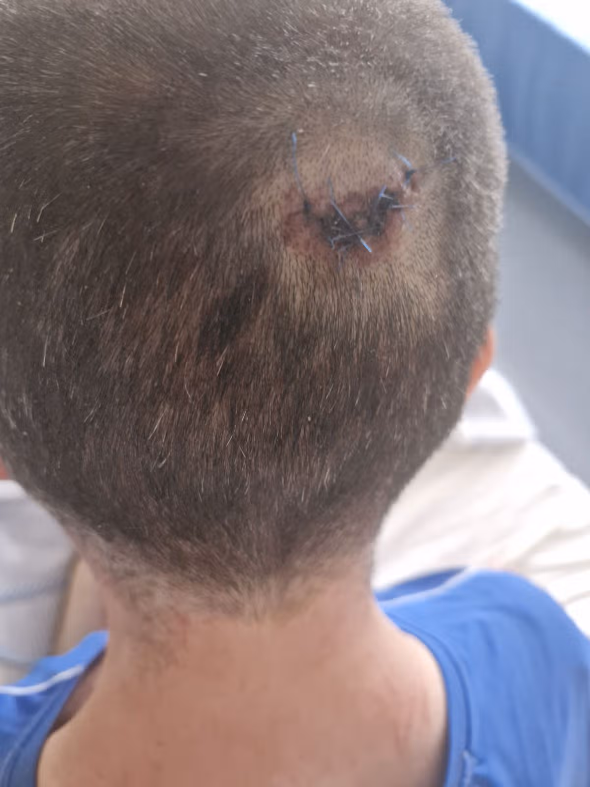 Dan's head injury (Kennedy News and Media)
