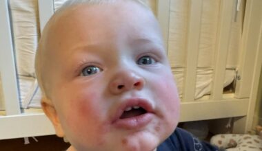 Hand, foot and mouth disease not a notifiable condition says Public Health