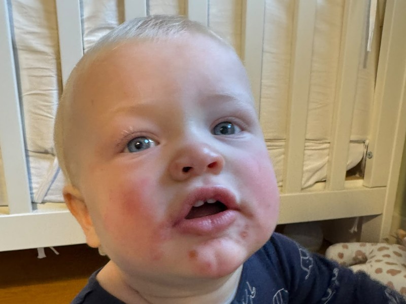 Hand, foot and mouth disease not a notifiable condition says Public Health
