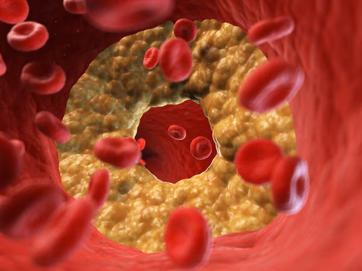 Illustration of a blocked artery.