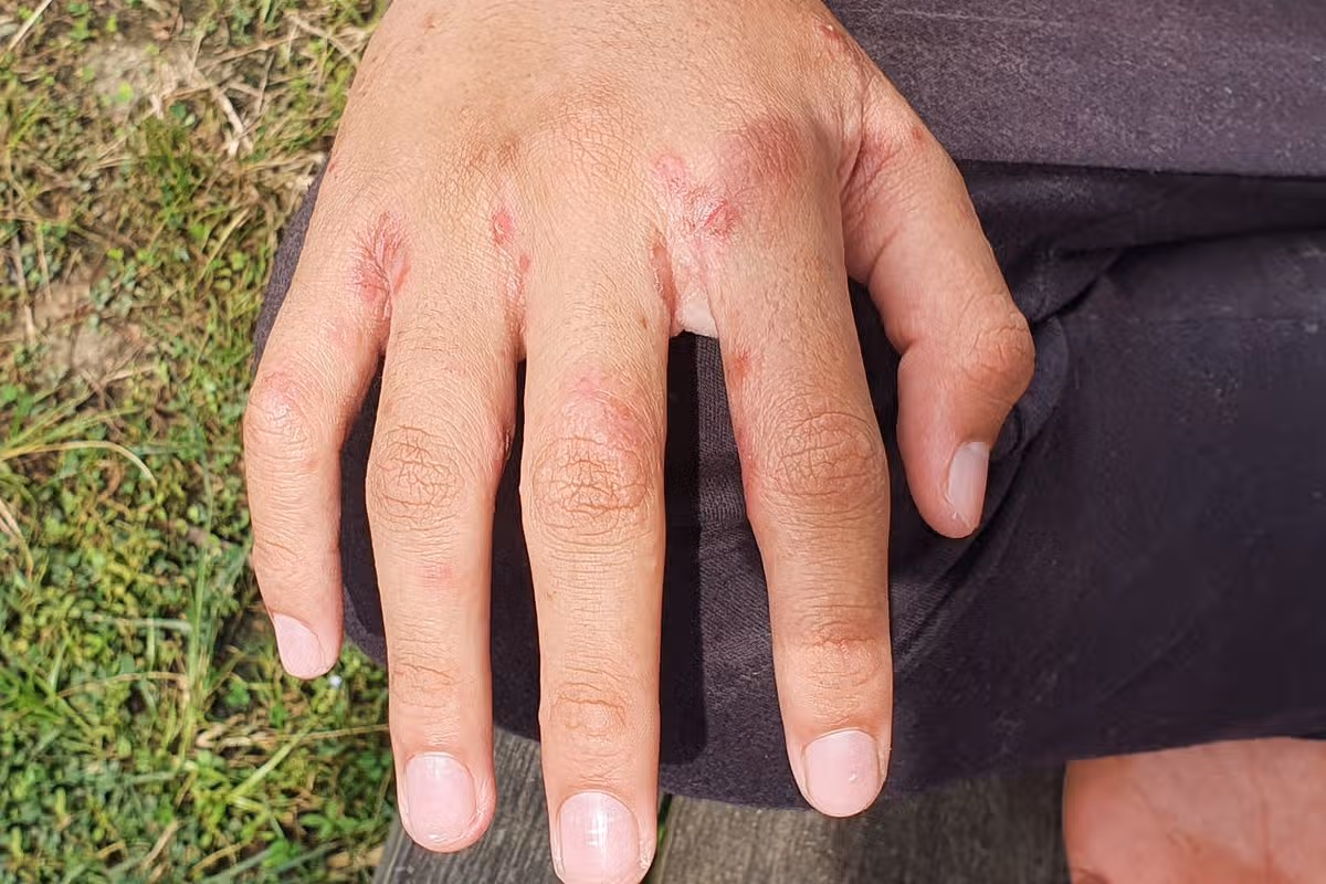 Scabies infects multiple parts of the body including in-between the fingers (file image).  
