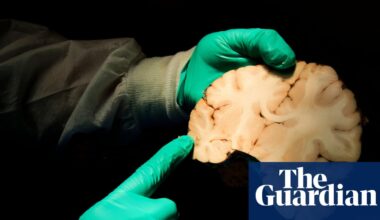 New study estimates 75% of deceased ex-NFL players had brain disease CTE | US news