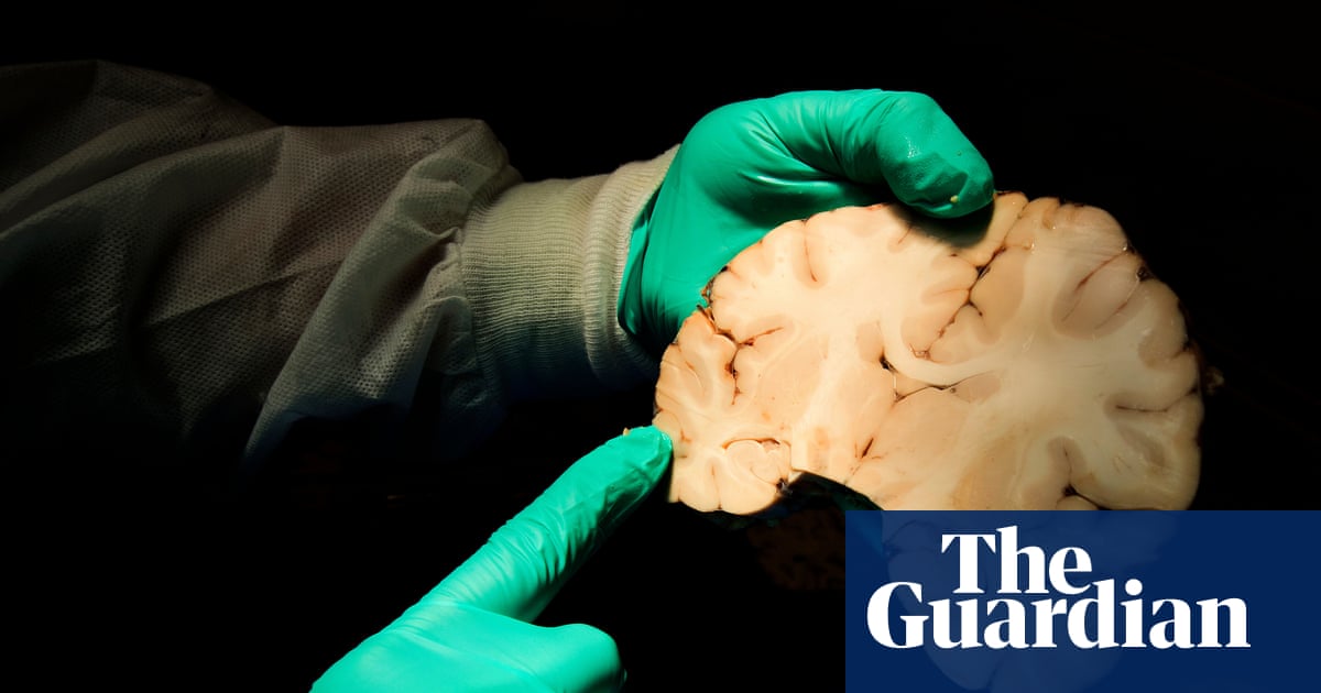 New study estimates 75% of deceased ex-NFL players had brain disease CTE | US news