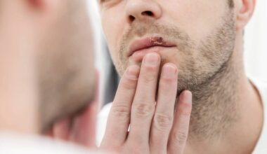 Megan Sheppard: Applying raw garlic to the cold sore is not something that I would recommend Picture: iStock