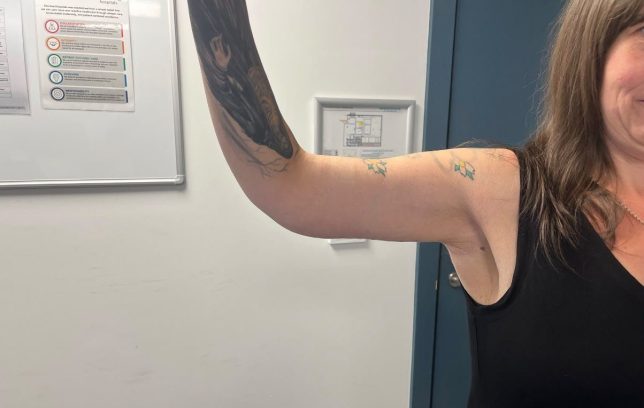 Samantha Middleton after skin reduction surgery that cost her almost £6,000