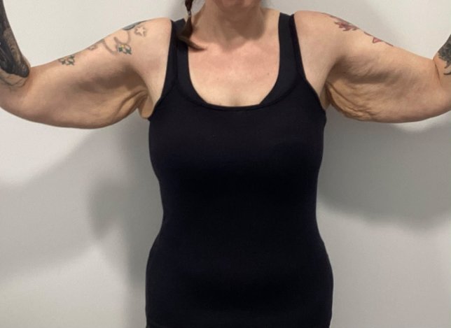 Samantha Middleton, before the £5,000 surgery to remove excess skin from her arms