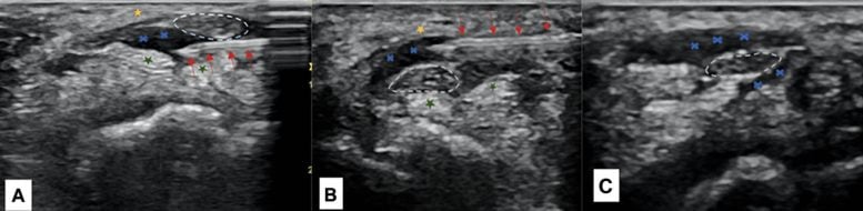 Ultrasound Images of Median Nerve Hydrodissection