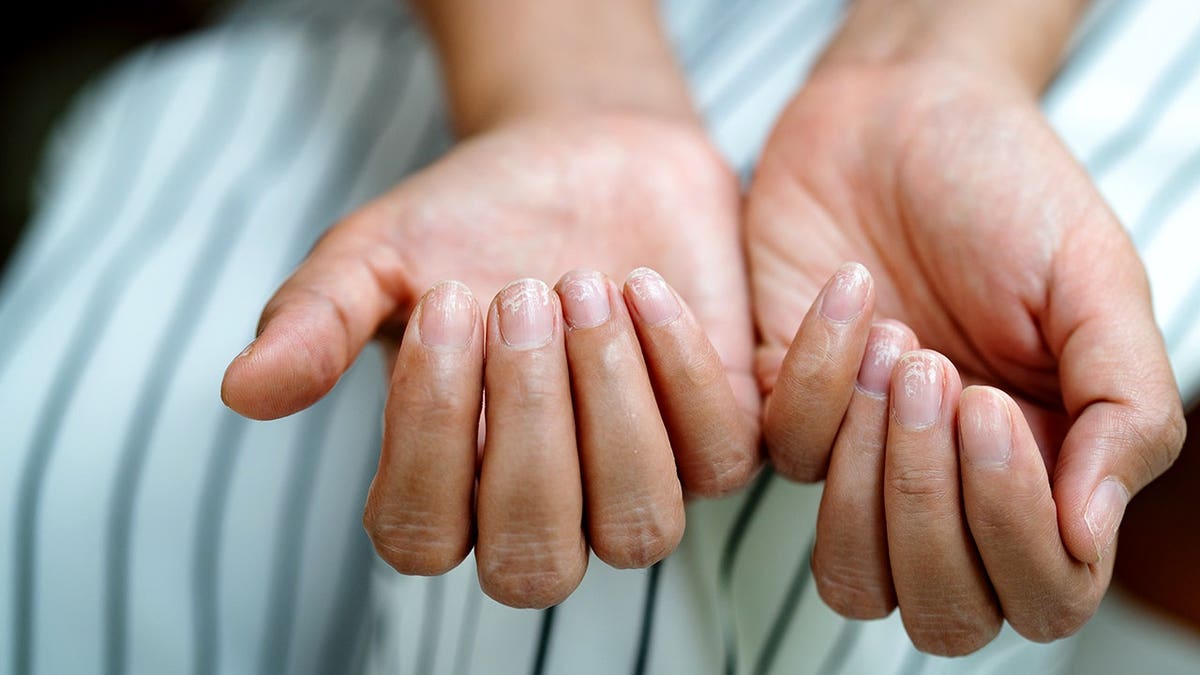 Damaged nails appear brittle and discolored after shellac or gel-lacquer use.