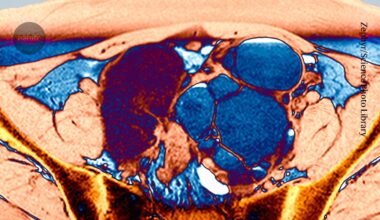 The ‘missed disease’ that affects 190 million: endometriosis drug shows early promise