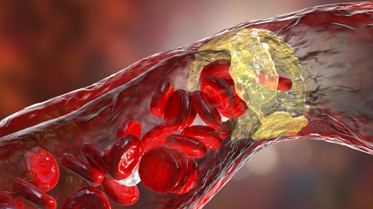 Cross-section illustration showing fatty plaque on the inner wall of an artery in a human.