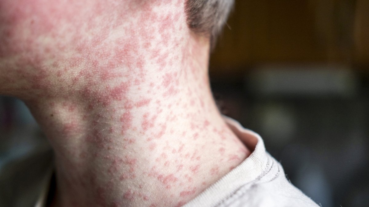 South Carolina measles outbreak is ‘accelerating’ – NBC 7 San Diego