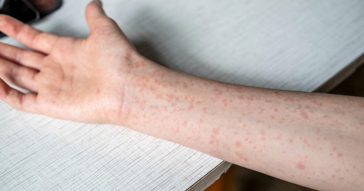 Oakland County reports new measles case, with a hospital as potential exposure site
