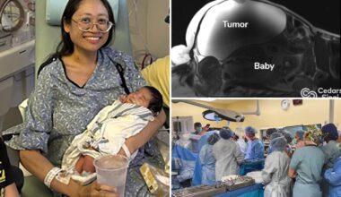 Doctors deliver baby while removing 22-pound tumor from Bakersfield woman