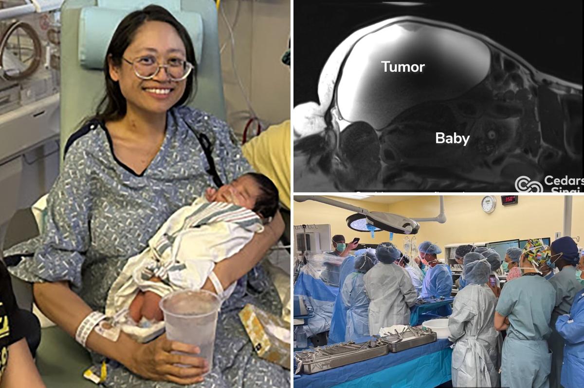 Doctors deliver baby while removing 22-pound tumor from Bakersfield woman