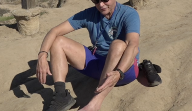 Former San Diego man recovers from flesh-eating disease caused by stingray sting