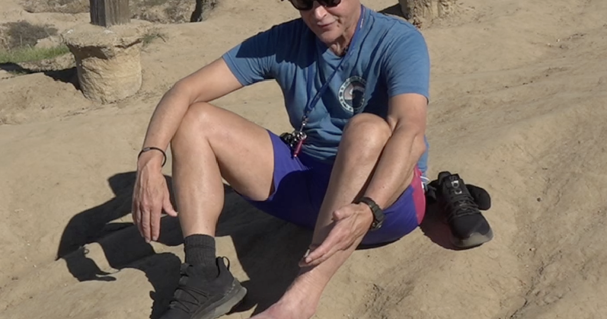 Former San Diego man recovers from flesh-eating disease caused by stingray sting