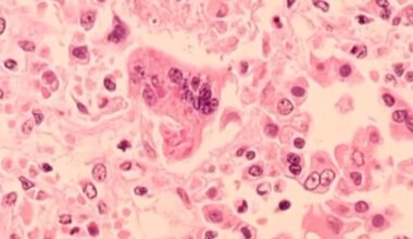 What to know about the reported measles case in Oakland County