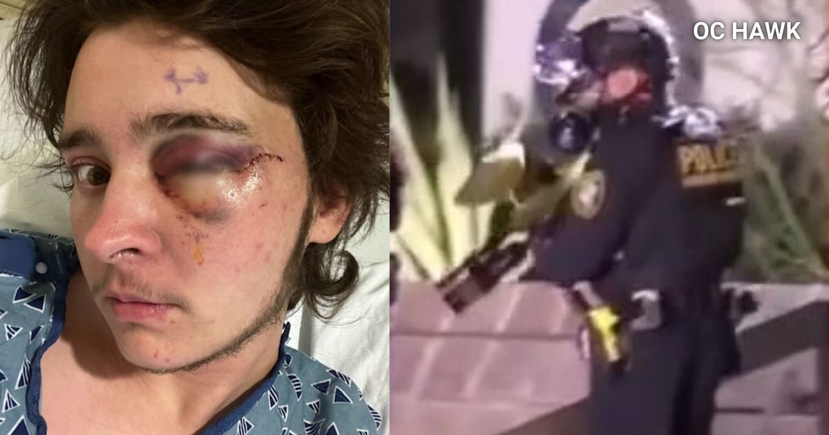 Anti-ICE protester claims he's now blind after federal officer shot him with nonlethal weapon in Santa Ana