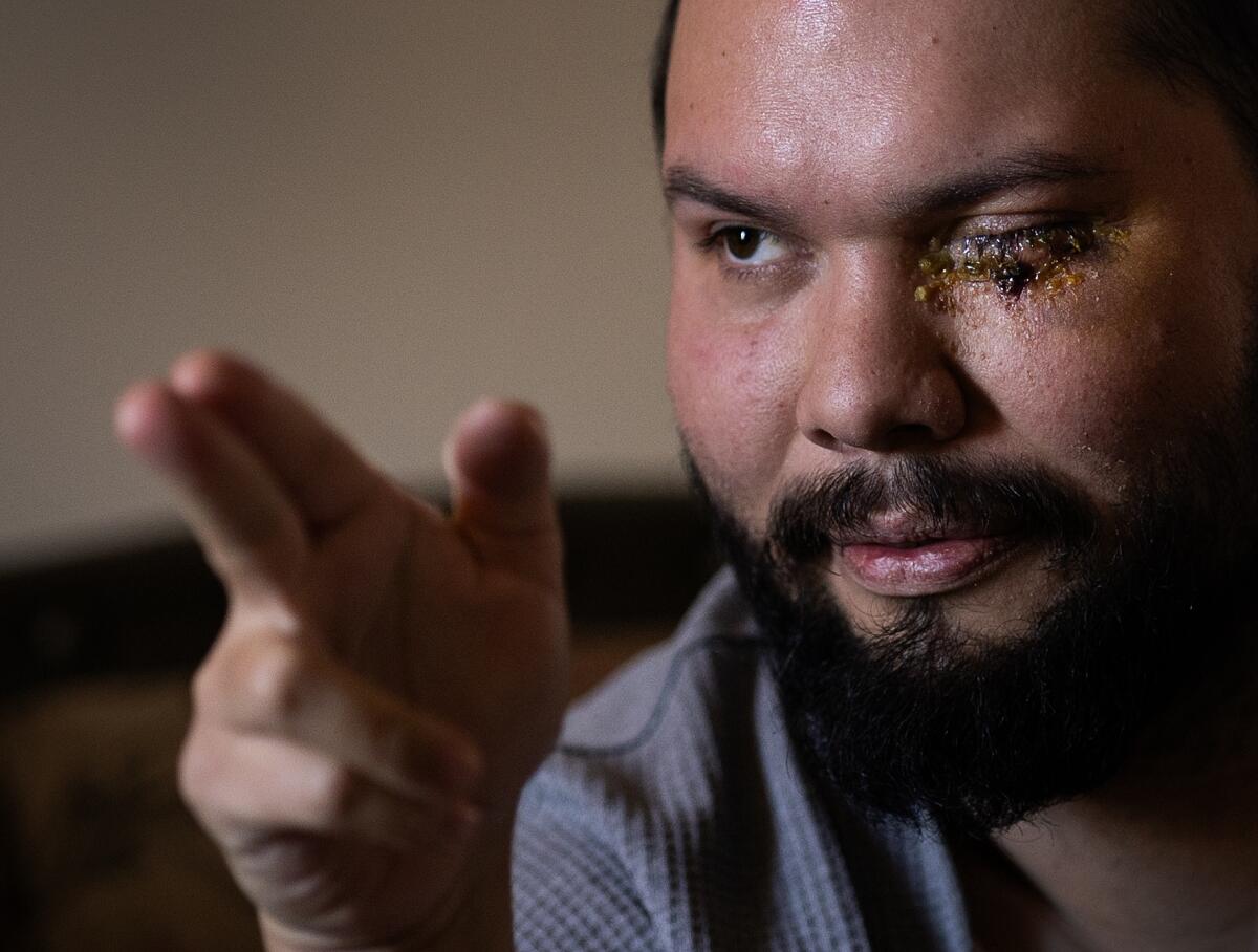 Britain Rodriguez tells his story of being shot in the eye.