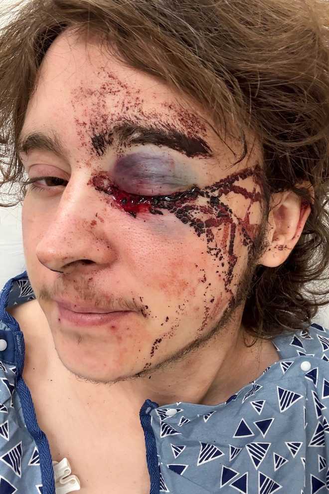 This Saturday, Jan. 10, 2026 selfie, provided by Kaden Rummler, shows an eye injury he sustained after being hit with a projectile fired by a federal agent during a protest outside an immigration building in Santa Ana, Calif. on Friday, Jan. 9, 2026. (Kaden Rummler via AP)