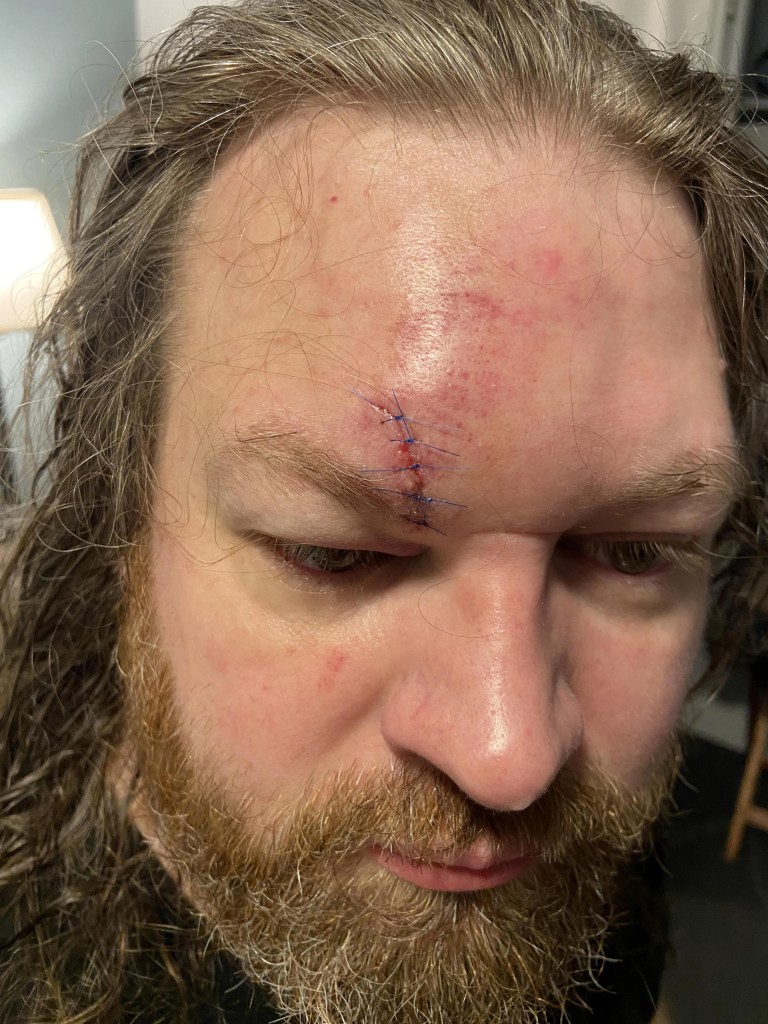 A man's forehead with stitches from a Disneyland brawl.