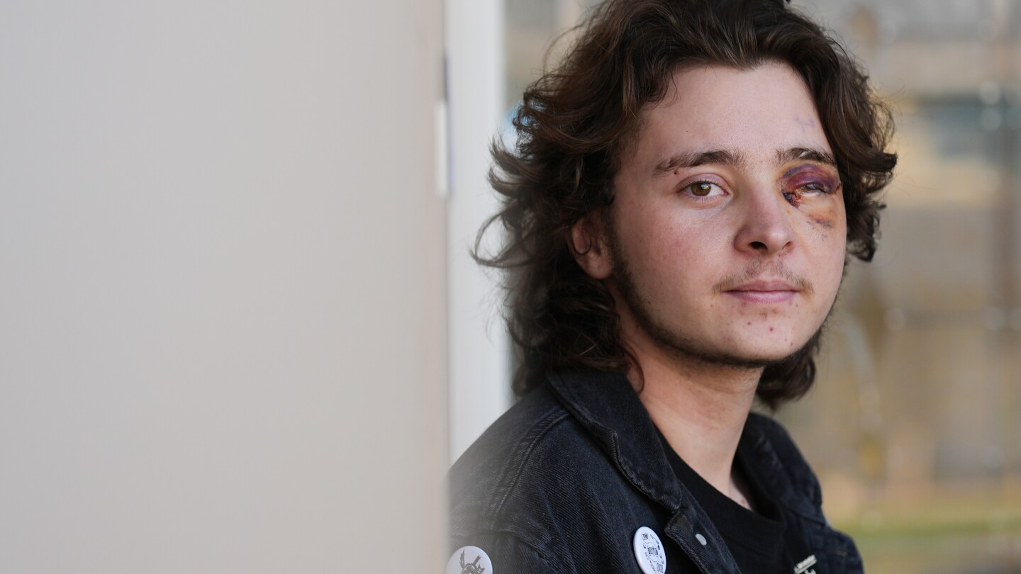 California protester blinded in one eye says his life will never be the same