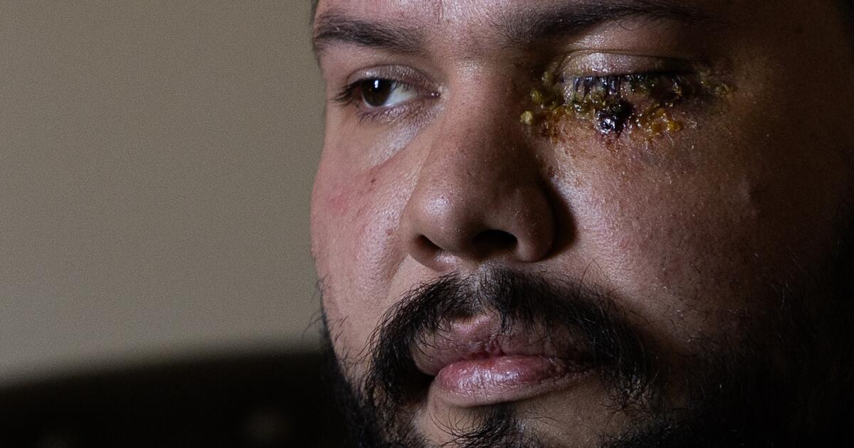 Second man says Homeland Security blinded him at anti-ICE rally